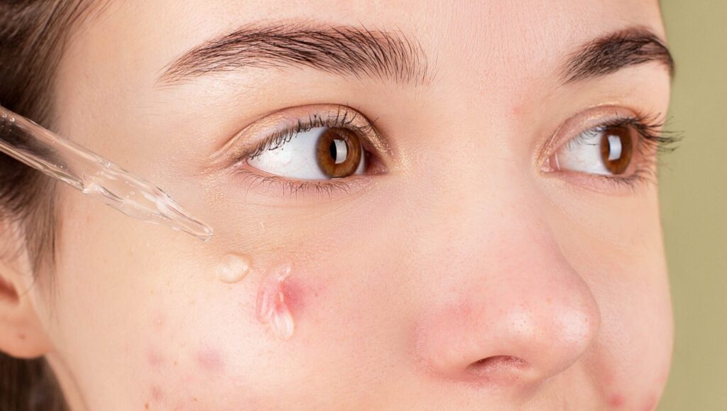 woman pouring vitamin c serum on her acne with a dripper