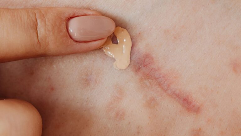 woman applying concealer on her scars to hide them