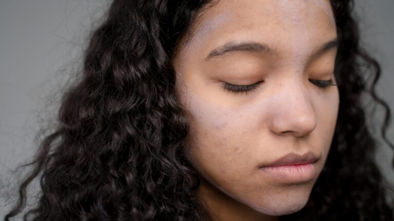 an afro woman looking sad as she suffers from acne scars