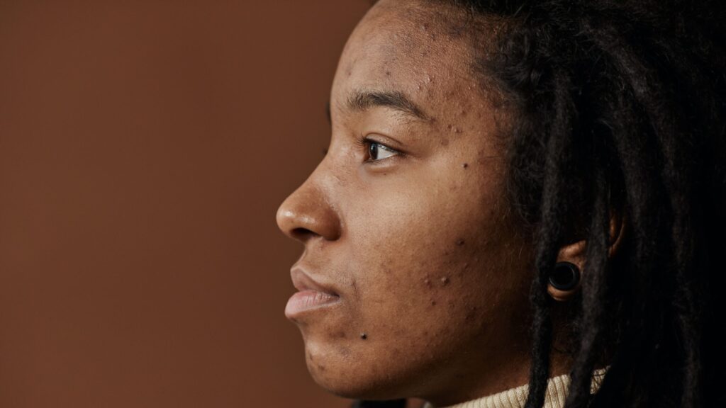 an afro woman's side profile as she suffers from acne scars