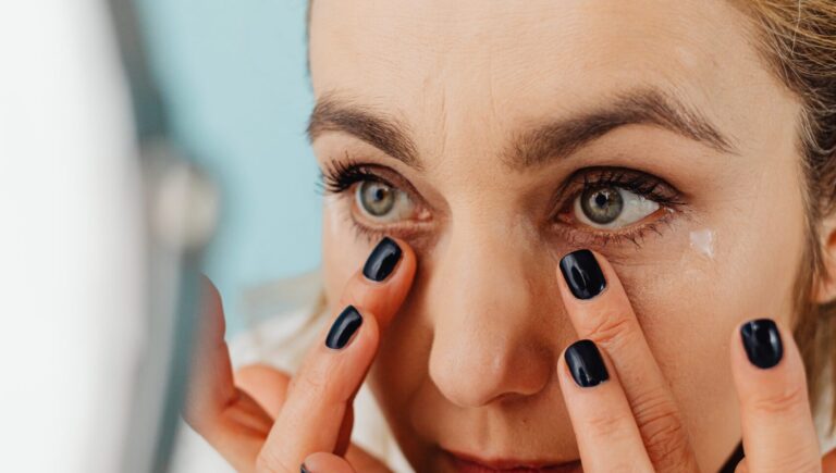 woman touching her under eyes after under-eyes fillers have been filled in them. she has a black nail paint on.