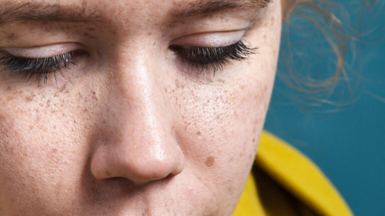 close up of a woman with beautiful features in a yellow hoodie dealing with acne scars before microdermabrasion