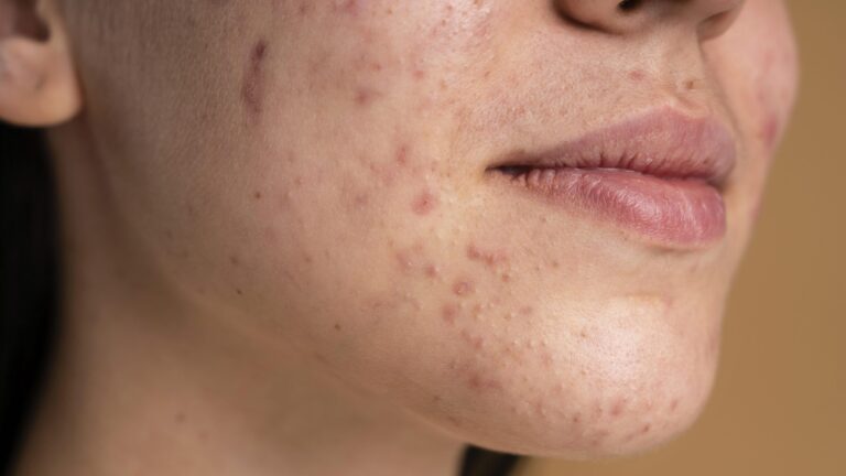 closeup of a womans mouth with acne scars before getting hydrafacial procedure done