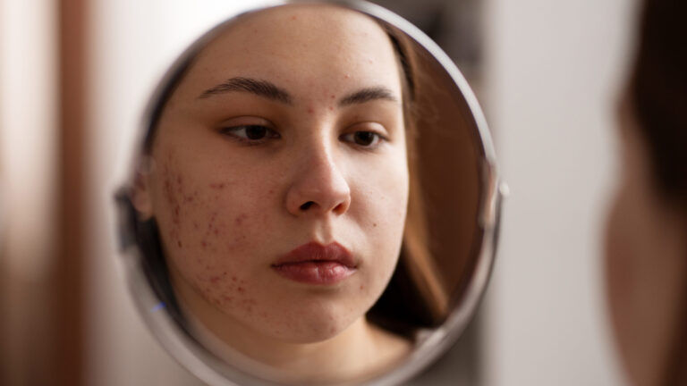 a woman looking at her acne scars before microdermabrasion