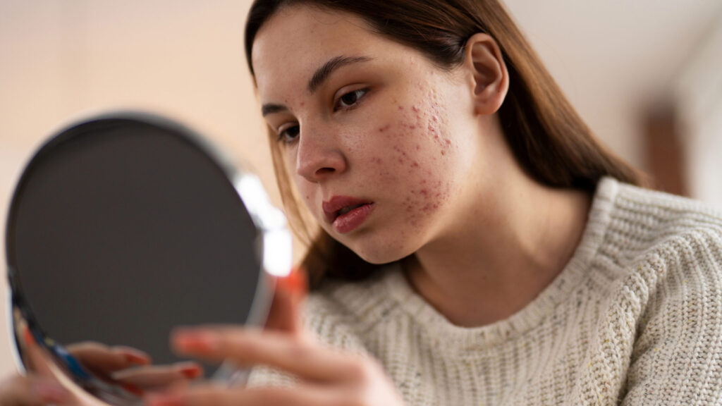 person dealing with acne scars before microdermabrasion