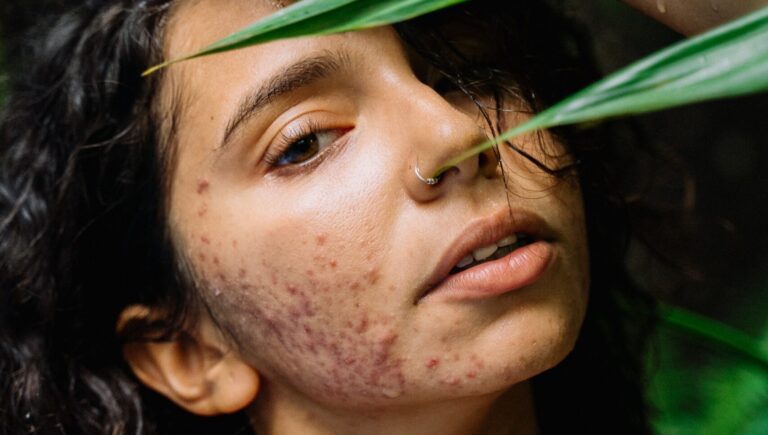 woman posing behind some green leaves, and she has acne scars on her face