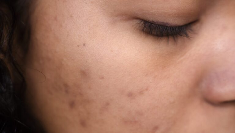 afro woman looking down and showing her acne scars