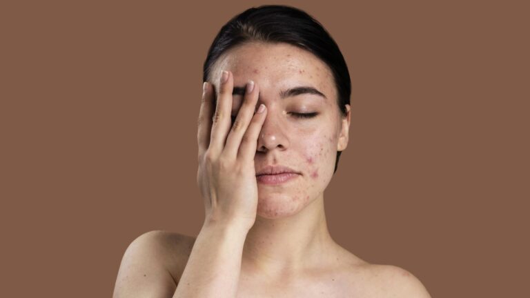 portrait young woman covering her face with her right hand and being confident with her acne scars