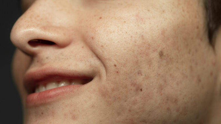 closeup of the face of a young man being confident with his acne scars and smiling