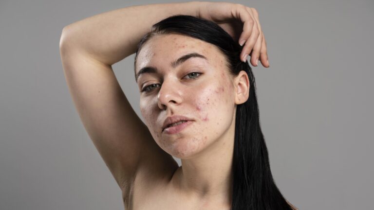 young woman showing her acne scars with confidence